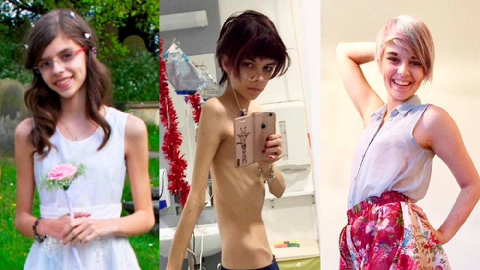 Vídeo: De la anorexia a un cuerpo sano en diez años | Actualidad | EL PAÍS